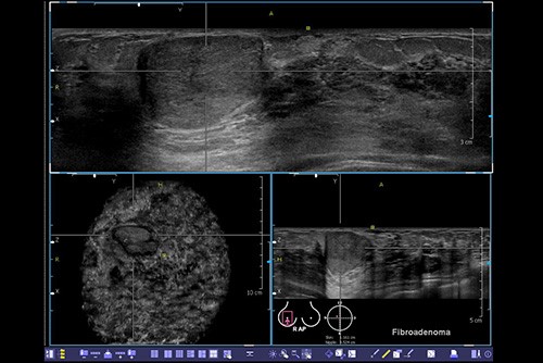 screen shot of breast ultrasound scan from a computer screen