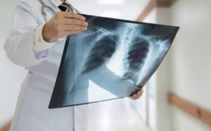 A photo of a doctor holding an X-ray image of the chest.