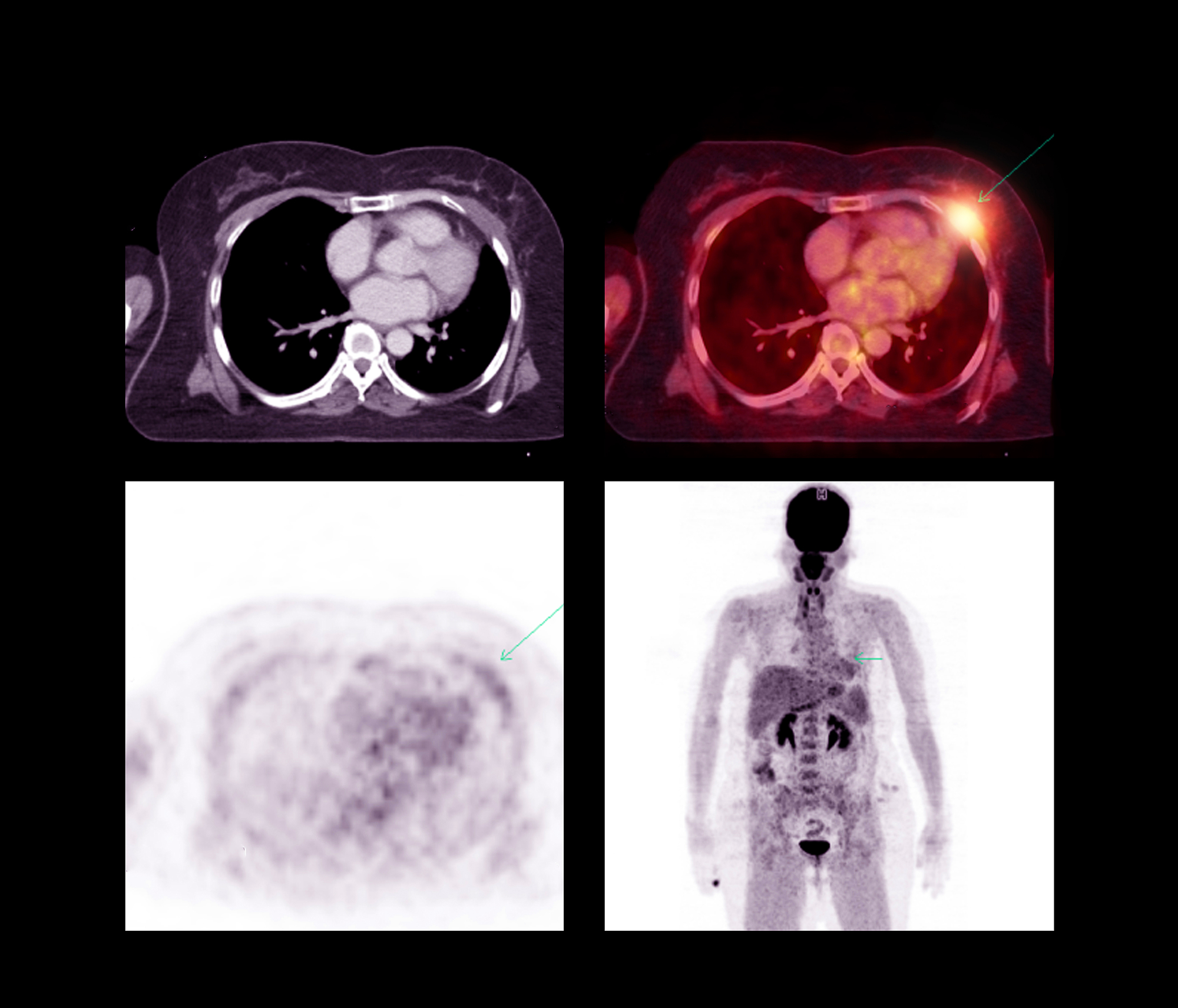 What Can A Pet Ct Scan Detect