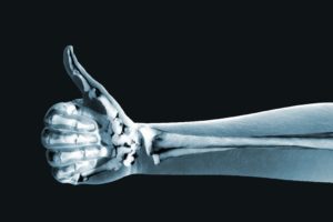 X-ray image of an arm and hand giving a thumbs up sign. 