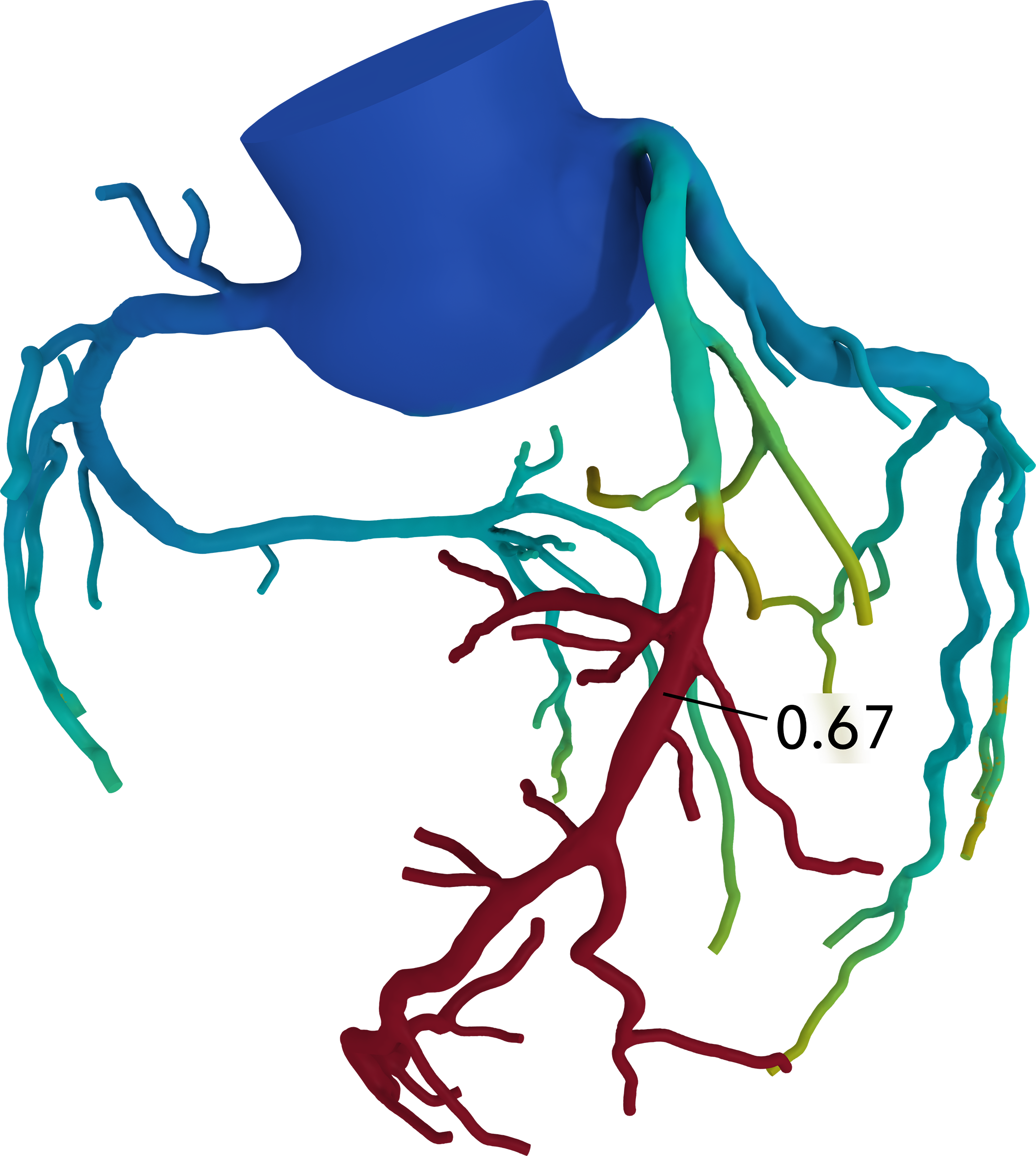 HeartFlow-3D Color Coded Model