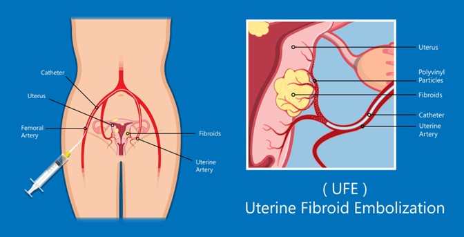 A diagram of uterine fibroid embolization with the catheter placement through the femoral artery into the uterine arteries