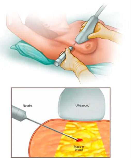 breast biopsy
