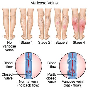 varicose veins