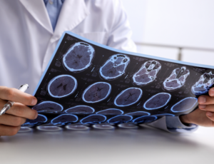 Close up of the chest of a doctor in a lab coat holding a brain MRI scan in both hands and a pen in one hand.