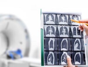 A hand holds CT scan images of lungs and points at them with a pen in the other hand with a CT machine in the background.